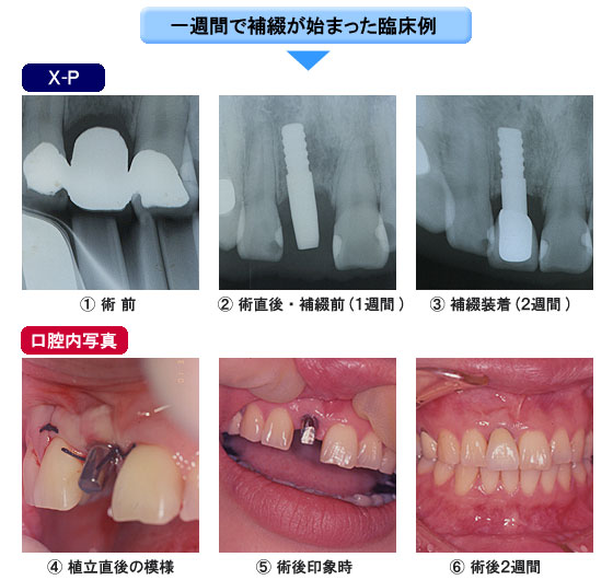 ソケットリフトに1ピースAQBを用いた症例