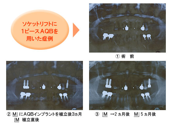 ソケットリフトに1ピースAQBを用いた症例