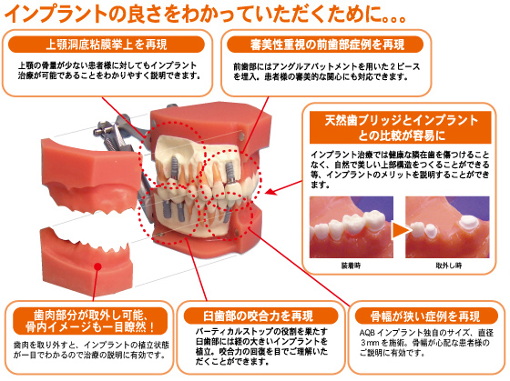 インプラントの良さをわかっていただくために。。。