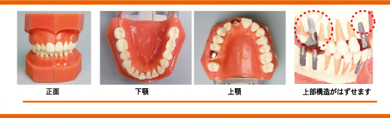 AQBインプラント顎模型は上部構造がはずせます